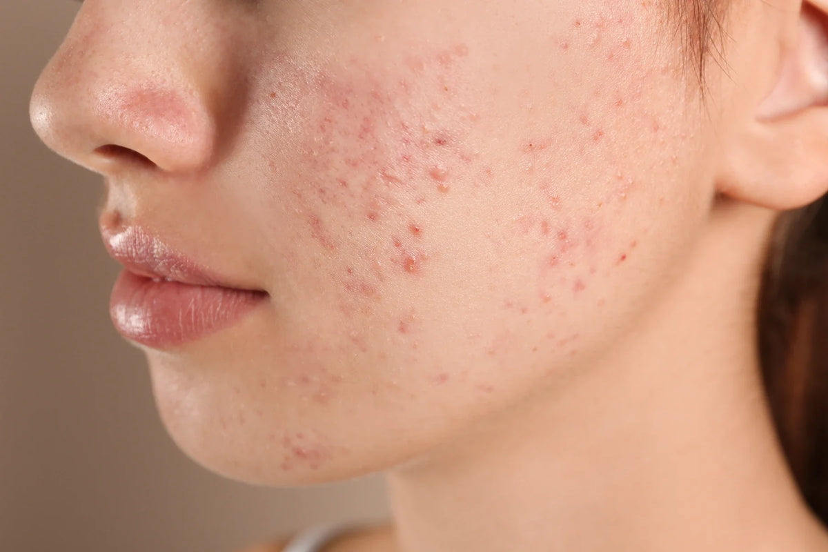 Acne en het huidmicrobioom: waarom C. acnes niet de vijand is