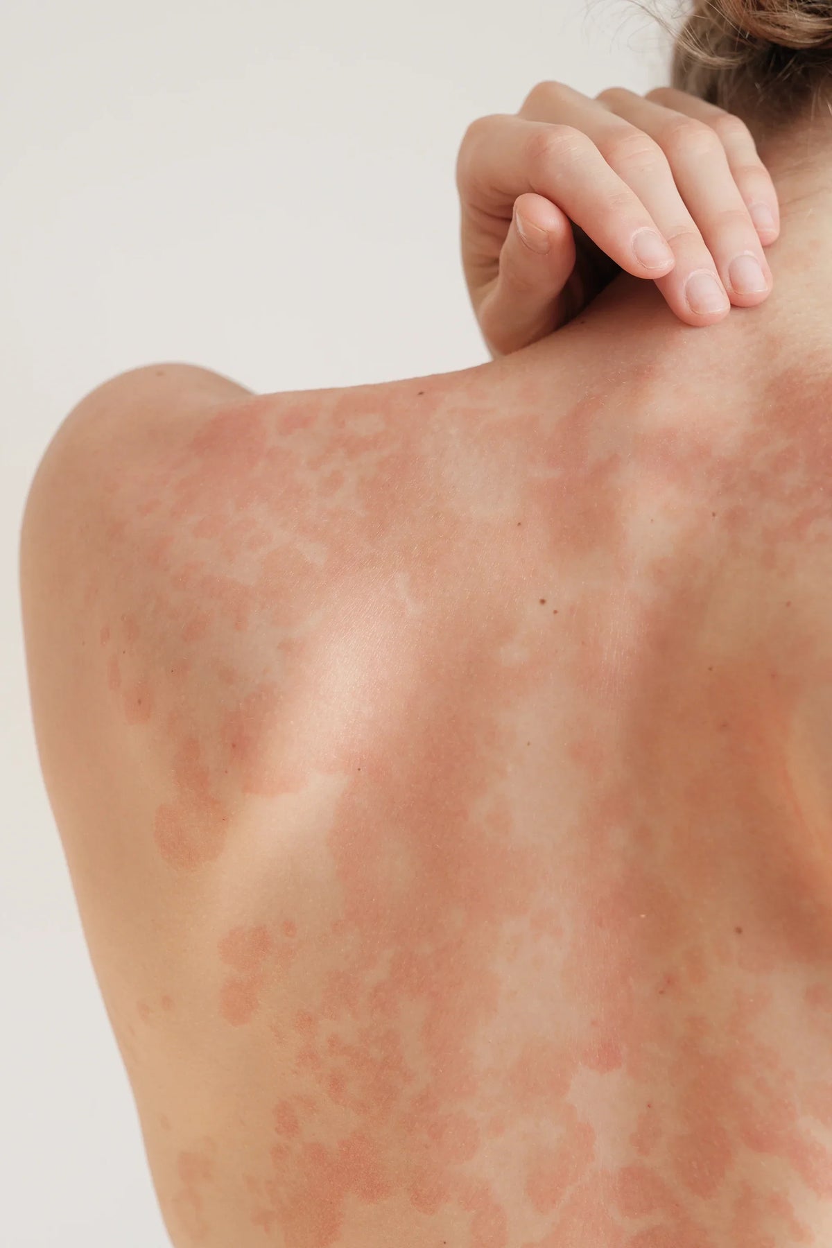 Huidbarrière & microbioom bij eczeemgevoelige huid