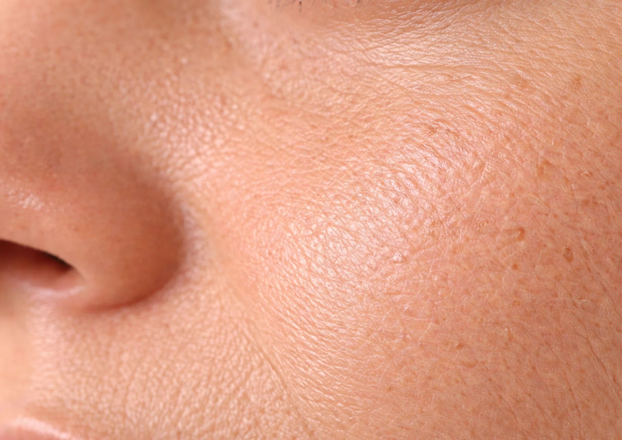 Huid met tekenen van veroudering